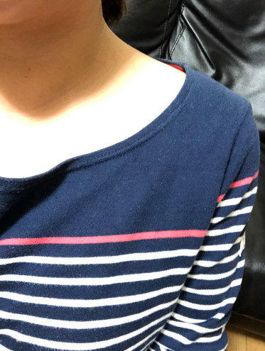 ヴェレダを使用する前の肩の写真