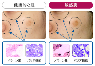 敏感肌のシミの写真