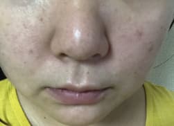 ブラックソープを使用する前の写真