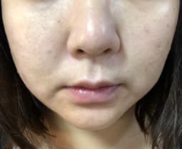 ブラックソープを使用した後の写真