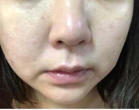 ブラックソープを2週間使用した後の写真