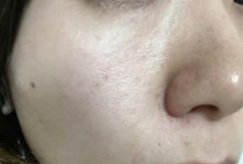 AGESTステムクリーム使用前の肌の写真