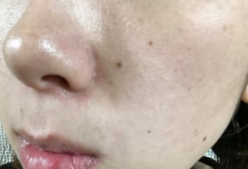 AGESTステムクリーム使用前の肌の写真