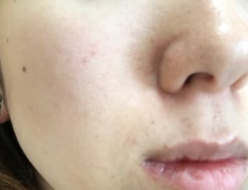 AGESTステムクリーム使用後の肌の写真