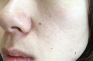 AGESTステムクリーム使用後の肌の写真